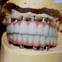 Le voyage à un sourire sain notre processus de couronne d'implant dentaire