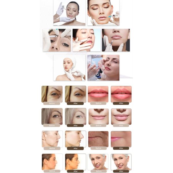 Revolax Dermal Filler Sub- Q для уменьшения длительных морщин