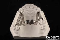 Clinical Practice Dental Alloying Metal Framework Good Fit In The Mouth Technology