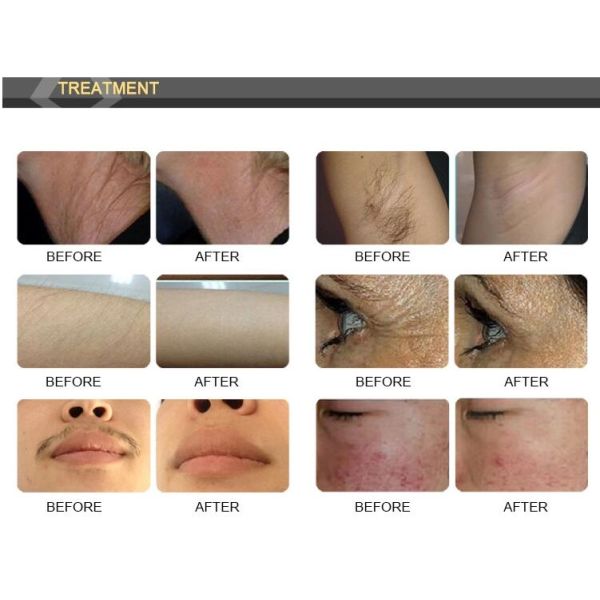 300000 Shots IPL SHR Hair Removal Machine Two Handles Type With UK Lamp