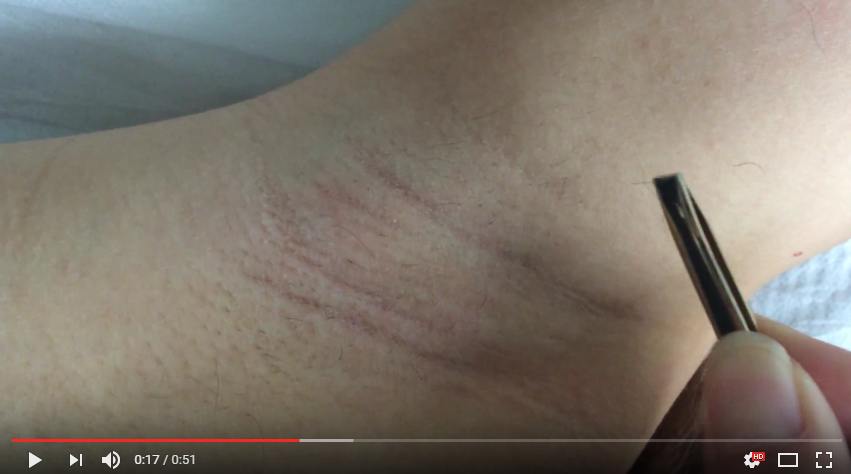 10 years factory best ipl machine price ipl epilator pulsed light professional