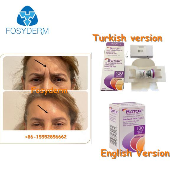 100Units Allergan Toxion Botulinum para removem o tipo facial A de Botox dos enrugamentos