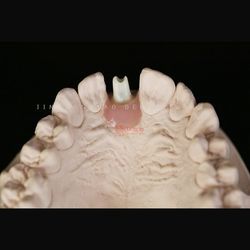 Dental Implant Restorations Custom Titanium Zirconia Abutment En China Dental Lab