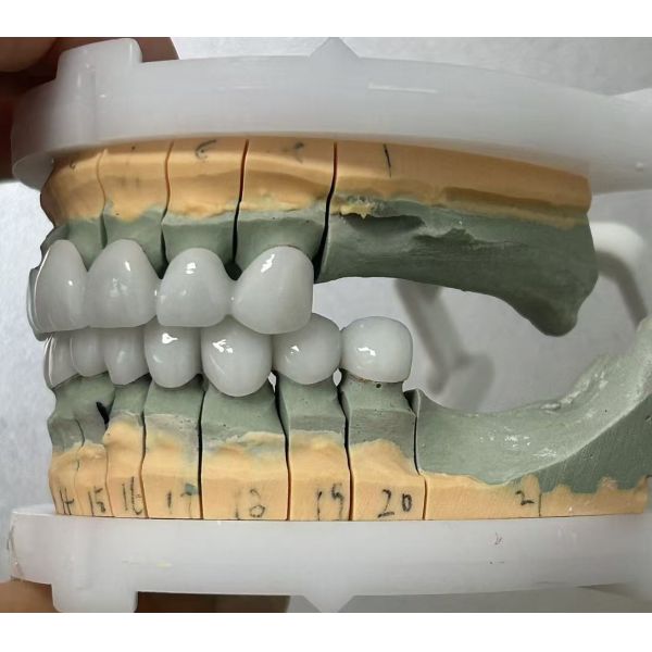 Full Zirconia dental bridge for high strength and durable dental restoration