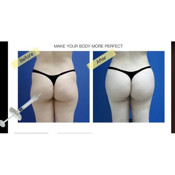 Inyecciones de ácido hialurónico en los labios Rellenes para labios de aspecto natural No quirúrgico Amplificación de labios