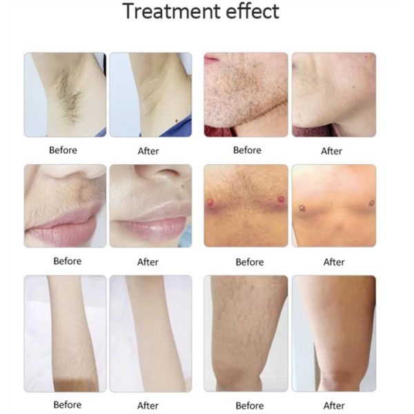 Desktop 808nm 810nm Diode Laser Machine Skin Whitening Body Hair Removal