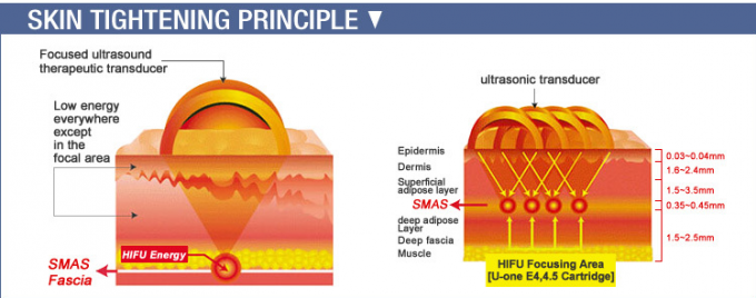 Painless Vertical To Skin Lift Hifu Machine , High Intensity Focused Ultrasound Machine