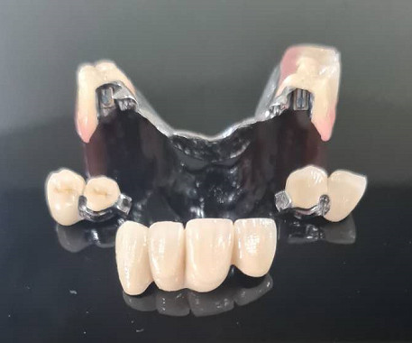 Metal Framework Precision Attachment Overdenture Removable Tooth Denture
