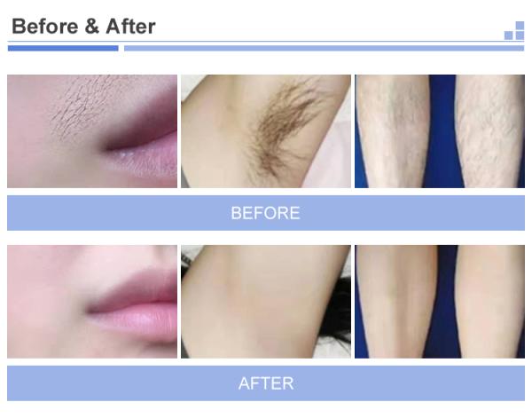 Painless Diode Laser Hair Removal Machine Professional Permanent Hair Reduction