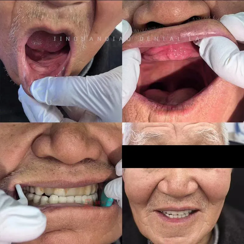 China Dental Lab Digital Full Dentures Using CAD/Cam Technology 3D Printing and Skilled Technicians