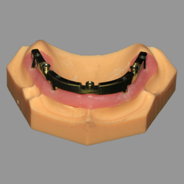 Lmplant Dental Laboratory | Full Acrylic Denture All On X Dental Lmplants AOX Class 4 With Locator Attachment