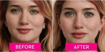 заполнитель лицевого дермального заполнителя впрыски Juvederm Voluma иглы шприца 2*1ml Hyaluronic кисловочный дермальный для стороны