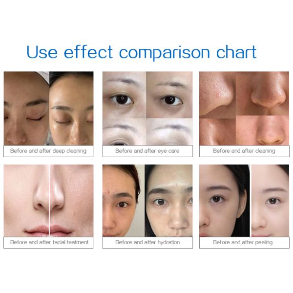 Sistema facial de burbujas calientes de oxígeno para pelar la piel