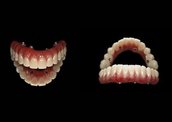 Customized Replacing Dental Implant Crown Wear Resistant For Long Term Use