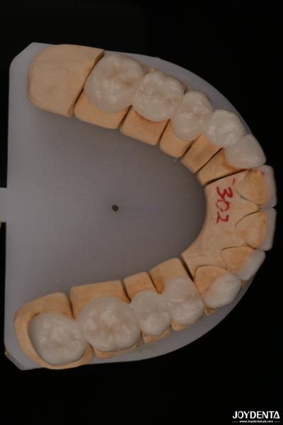 0.3mm Thickness Ips Emax Veneers Ceramic Veneers Anterior Posterior Restorations
