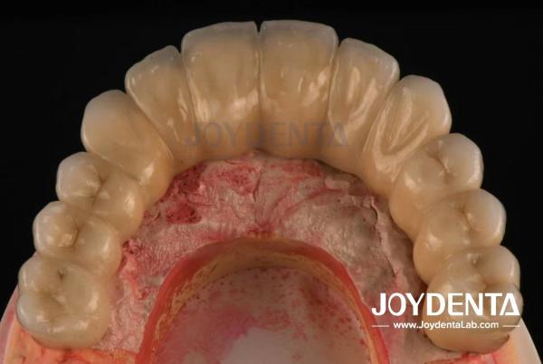 Casting And Milling PFM Tooth Crown , Dental Restorations Porcelain Fused Metal Crown