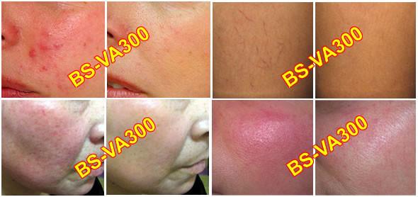 Vein Vascular removal 30MHz spider vein blood vessel removal vascular removal beauty equipment