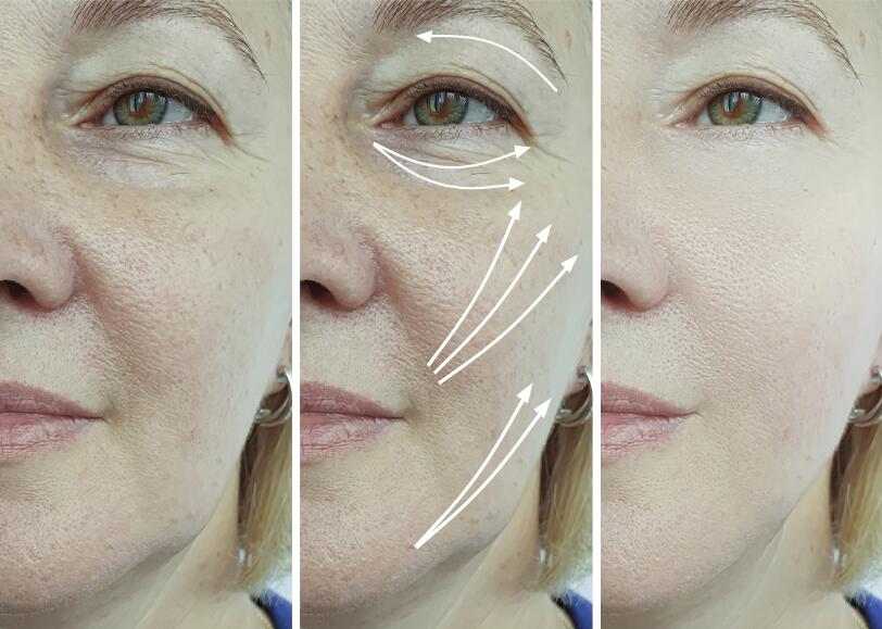 Заполнитель 5ML Skinject Hyaluronic кисловочный дермальный для щеки губ
