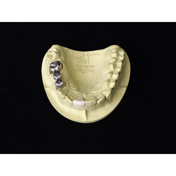 Audental 04 aleación noble de plata-paládio porcelana aleación blanca Pd53.3% para restauraciones dentales de larga duración