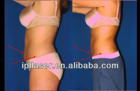 HIFU Liposonix 2 in 1 Beauty Machine for face lifting and shaping / slimming