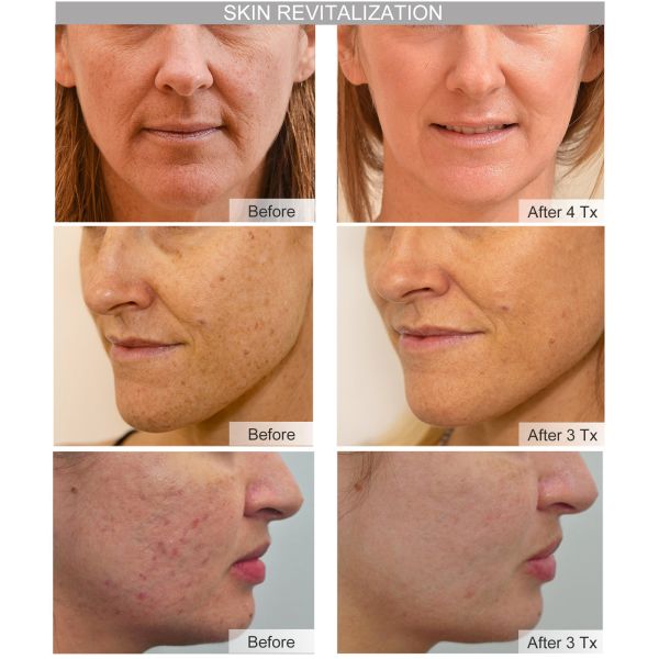 450ps Picolaser Q Switched Nd Yag Laser 1064nm 532nm Stationary