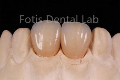 High Translucency Multi Layer Zirconia For Fabrication Of Dental Restorations