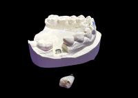 Implant dentaire avec couronne en céramique et abutement en titane pour molaire
