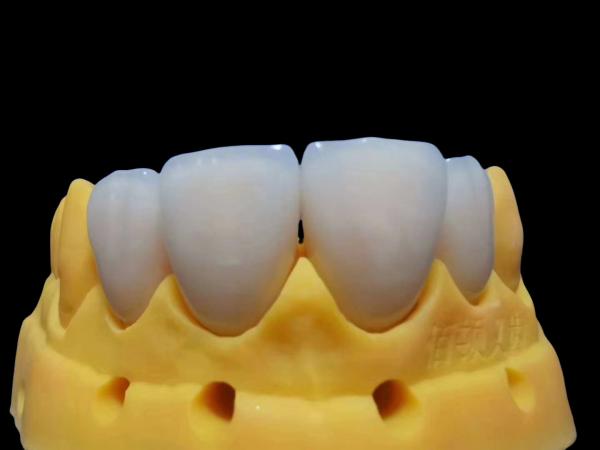 High Esthetics Dental Lab Crowns Porcelain Layered Zirconia Staining Resistance