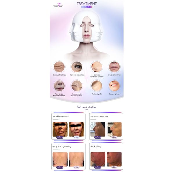 Обработка красоты подтяжки лица машины Rf Hifu не инвазионная