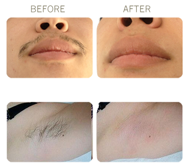 120 J/Cm2 808 Diode Laser Hair Removal Machine Skin Rejuvenation