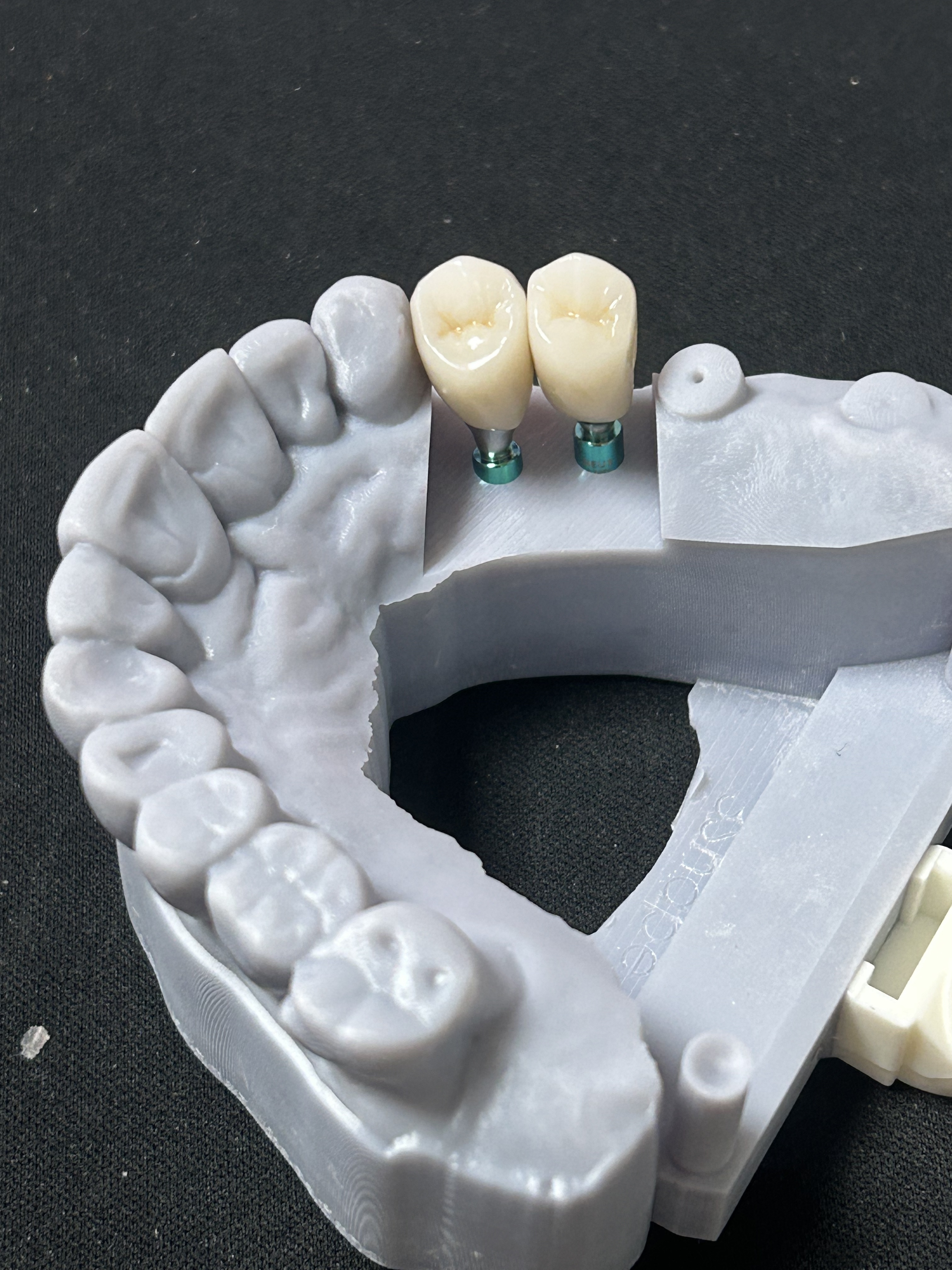 High-Strength Zirconia Implant Restoration with Natural-Looking Appearance and Digital CAD/CAM Manufacturing