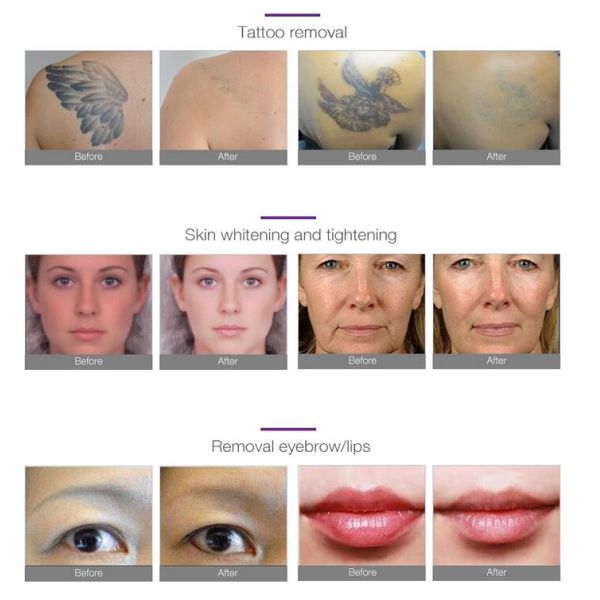 Clinical Q Switched Nd Yag Laser Tattoo Removal Machine 1064nm 532nm 1320nm Available