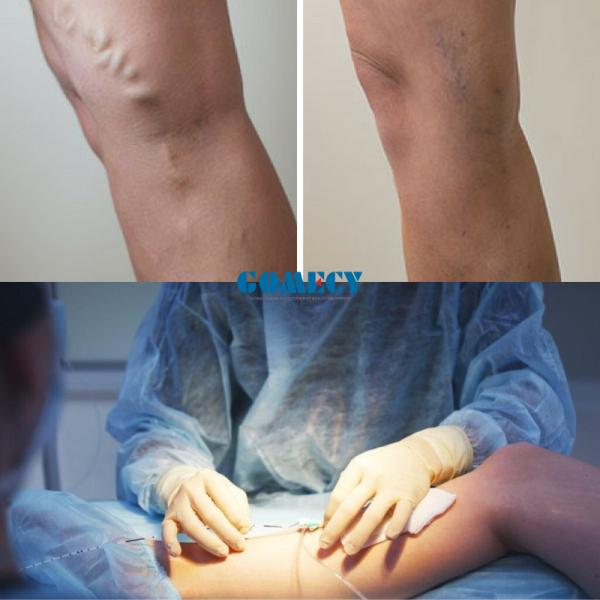 Dual Wavelength 980nm 1470nm Diode Laser Medical System for Endovenous Vein Treatment, Varicose Vein Closure, Leg Vein Therapy, Vascular Surgery, Minimally Invasive Vein Removal Device