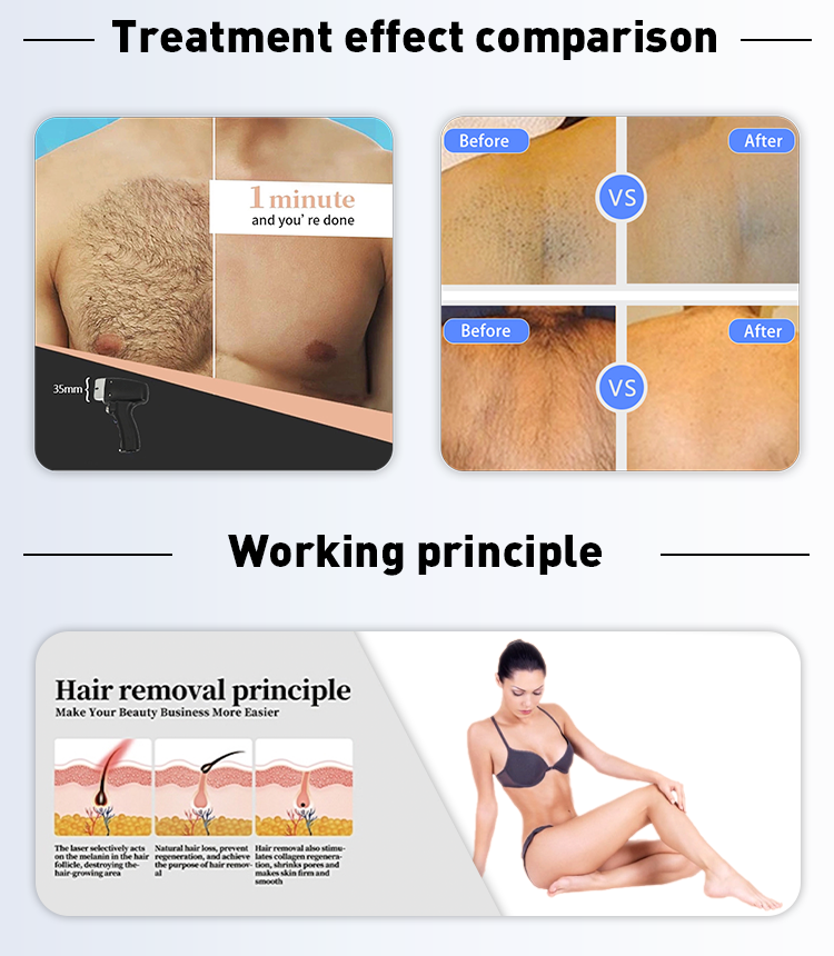 1200W 1600W портативный диодный лазерный эпилятор Диодный лазерный эпилятор