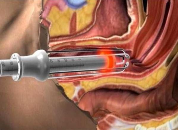 Vaginal tightening machine USA RF tube Fractional CO2 laser machine vaginal tightening