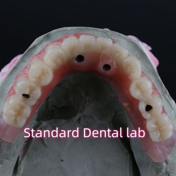 Puente de implantes dentales de porcelana de zirconia alta estética profesional con chicle rosa