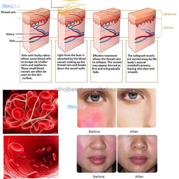 High Frequency Laser Vascular Removal Machine For Spider Vein Removal