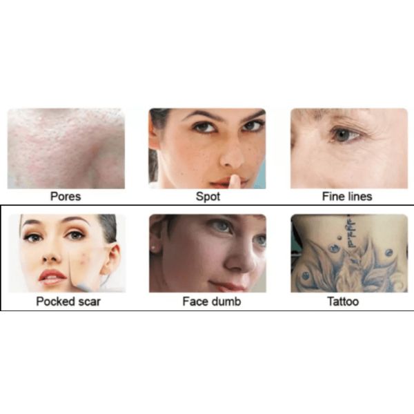 машина 2mm удаления татуировки лазера picocare 1-10Hz 3mm