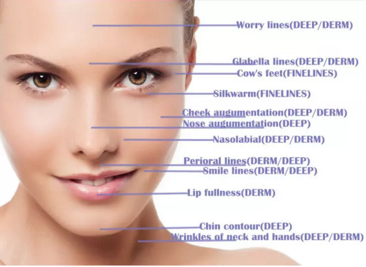 Точным форма соединенная крестом Skinject Hyaluronic кисловочная дермальная заполнителя геля 2ml