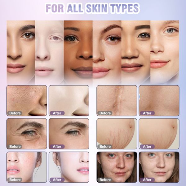 Máquina láser fraccionada de CO2 para la eliminación de pecas de cicatrices Máquina de corte láser de CO2 para uso doméstico Equipo de belleza