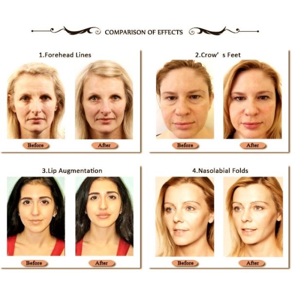 Juvederm Voluma 	Вводимый дермальный заполнитель пластиковый Chin обнюхивает ровные морщинки