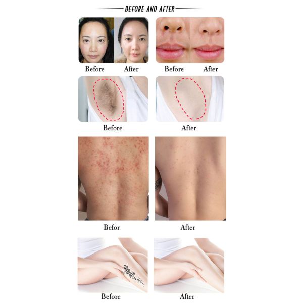 480/530/640nm OPT IPL Laser Beauty Equipment Skin Freckle Removing