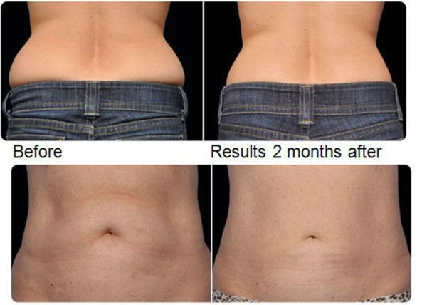  Fat Freeze Slimming Machine For Body Sculpture / Weight Reduction