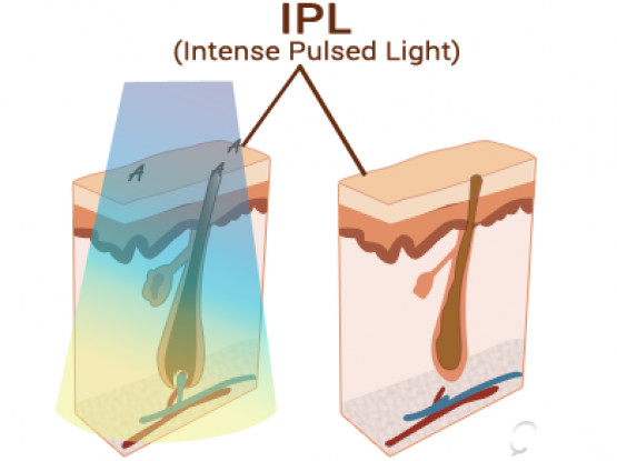 3 In 1 Nd Yag Laser IPL SHR Hair Removal Machine Vascular Treatment Body Slimming