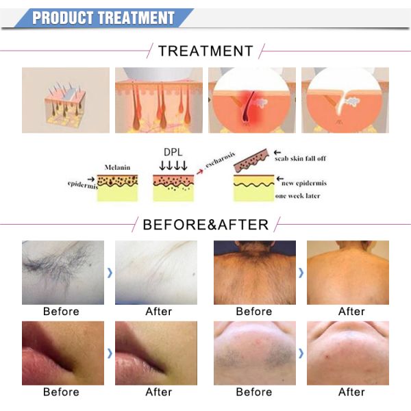 Multi-Functional Beauty Equipment IPL RF Cavitation Laser 5 in 1 2000W Energy 1-36J/cm2