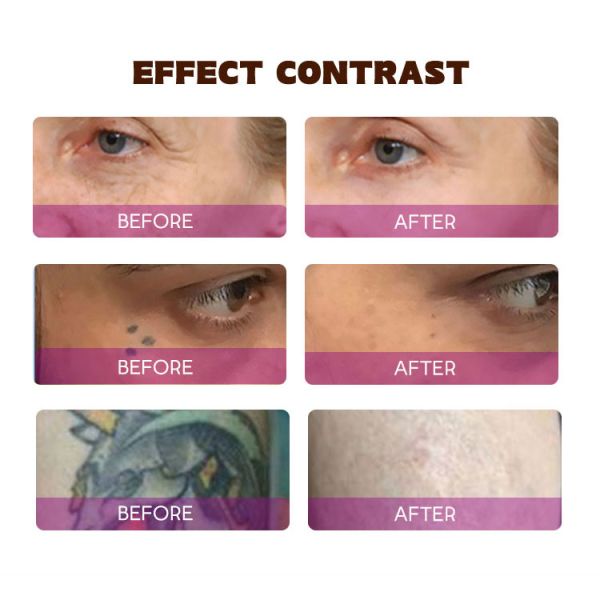 Advanced Pico Laser Technology for Fast and Effective Tattoo Removal at 1064nm 532nm
