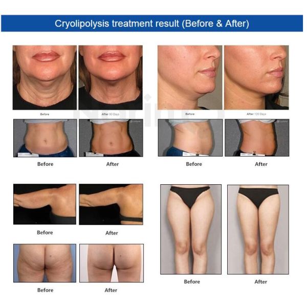 Portable Cryolipolysis Cavitation RF Lipo Laser Body Slimming Equipment