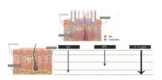 Salon Laser Hair Removal Machine / Ipl Laser Hair Removal Device