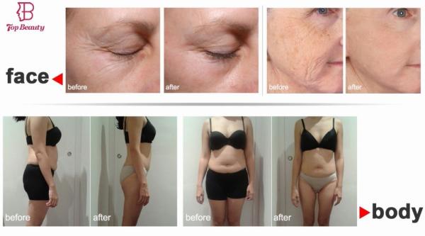 Ice Ret Cet Rf Skin Tightening Face Lift Machine Stationary