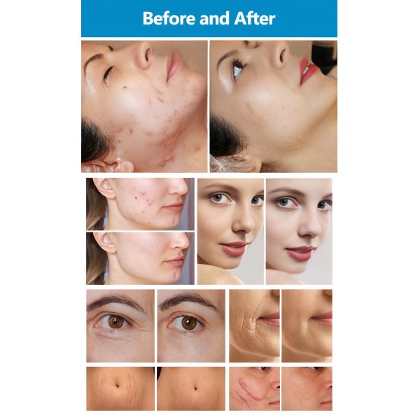 Medical Fractional CO2 Laser Device 60W For Acne Scar Treatment / Skin Rejuvenation